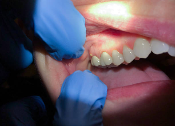Best Dental Abscess Treatment in Nashville, TN
